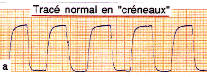 Normal crenellated trace