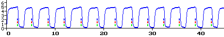 Normal Waveform - Asthmatic - Capnography - Asthma