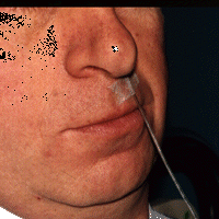 Catheter fixed to the upper lip