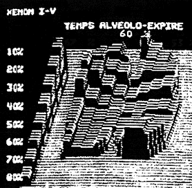 Xenon 133 : abnormal alveolar emptying during  attack