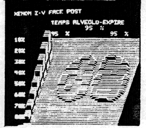 Xenon 133 : normal alveolar emptying